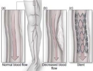 What is Nitinol used for? - Special Metal & Machined Parts Supplier ...