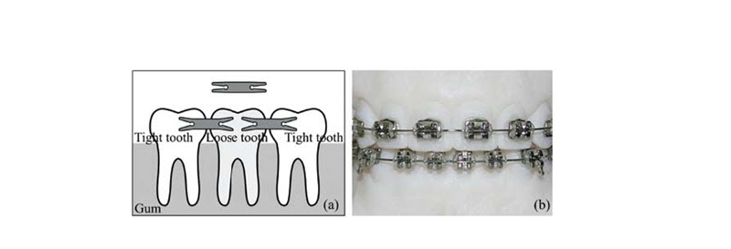 Nickel-Titanium (Ni-Ti) Shape Memory Alloy Used in Stomatology